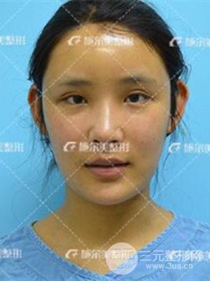 江苏施尔美自体脂肪填充面部案例，前后对比图分享
