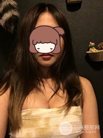 职业模特做了假体隆胸手术分享手术恢复照片