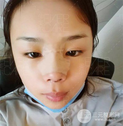 北京伊美尔徐军假体隆鼻前后对比照片心情日记