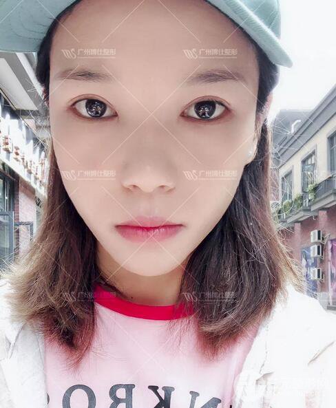 广州博仕整形双眼皮案例术后恢复日记