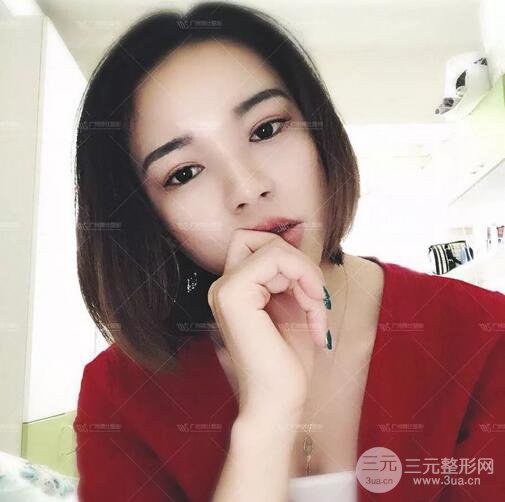 广州博仕整形双眼皮案例术后恢复日记