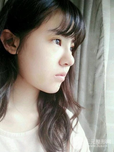 广州美莱李高峰隆鼻整形案例前后对比图分享~