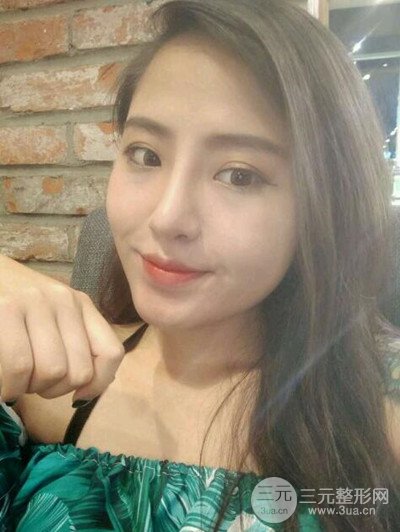 广州美莱李高峰隆鼻整形案例前后对比图分享~