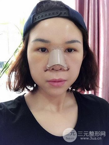 隆鼻整形手术真人案例恢复过程分享 附上果图