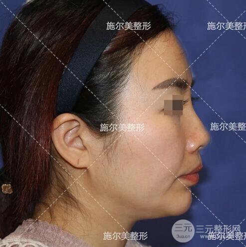南京施尔美刘道功隆鼻案例术后恢复实记