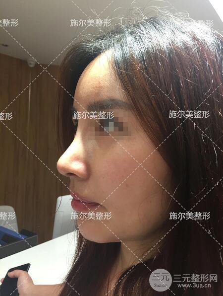 南京施尔美刘道功隆鼻案例术后恢复实记