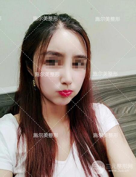 南京施尔美刘道功隆鼻案例术后恢复实记