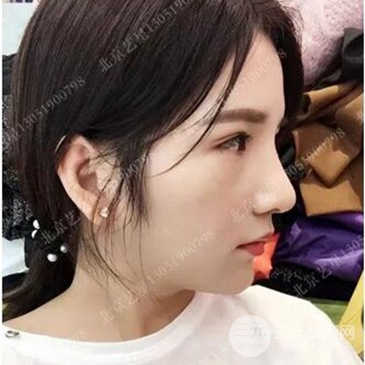 北京艺星隆鼻整形案例前后对比图分享~