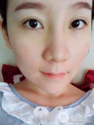 北京伊美尔徐军隆鼻整形前后对比照片心情记录小札