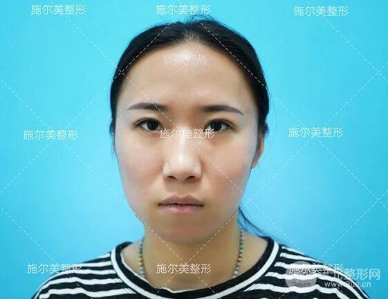 南京施尔美玻尿酸注射案例,让苹果肌嘭嘭嘭！
