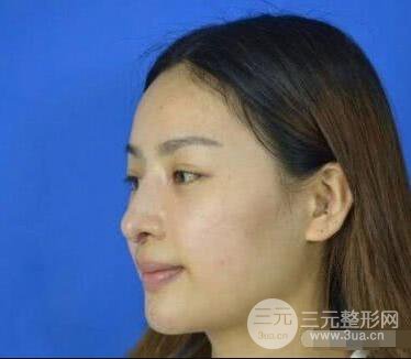 吉林铭医李红肋骨隆鼻整形前后对比图果恢复心情小札