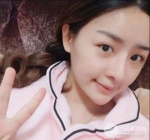 吉林铭医李红肋骨隆鼻整形前后对比图果恢复心情小札
