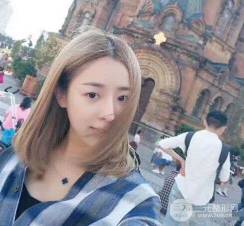 吉林铭医李红肋骨隆鼻整形前后对比图果恢复心情小札