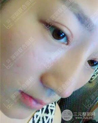 深圳联合丽格线D隆鼻恢复日记以及前后对比图分享！