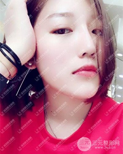 深圳联合丽格线D隆鼻恢复日记以及前后对比图分享！