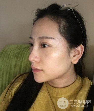 内切微创去眼袋手术案例分享，附上手术恢复照片