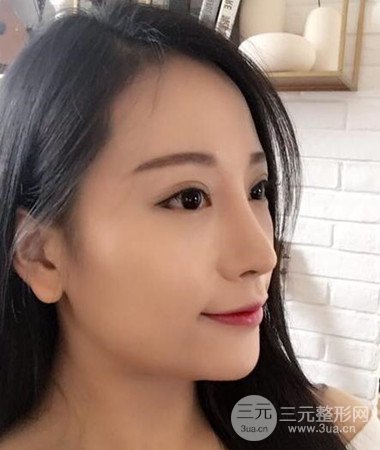 内切微创去眼袋手术案例分享，附上手术恢复照片