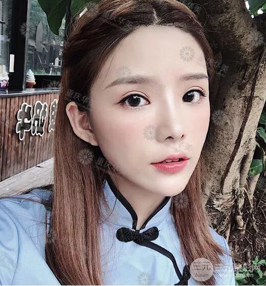 重庆万州华美潘宝华双眼皮+内眼角前后对比图被赞气质港风女神!