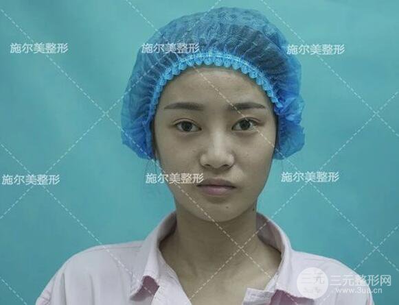南京施尔美双眼皮+隆鼻案例术后恢复日记