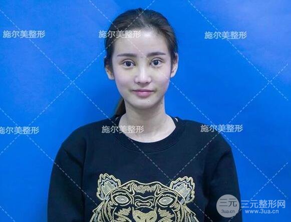 南京施尔美双眼皮+隆鼻案例术后恢复日记