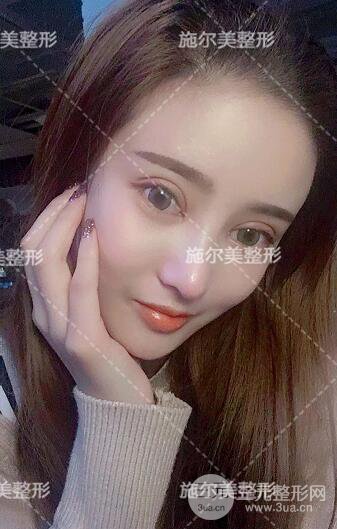 南京施尔美双眼皮+隆鼻案例术后恢复日记