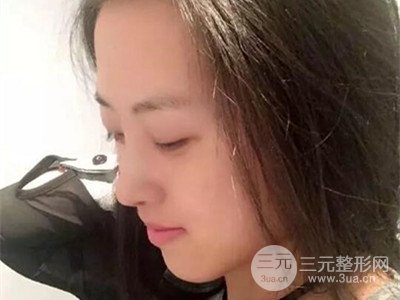 长沙鹏爱彭正春假体隆鼻案例分享