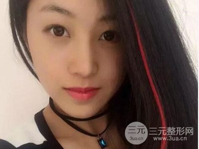 长沙鹏爱彭正春假体隆鼻案例分享