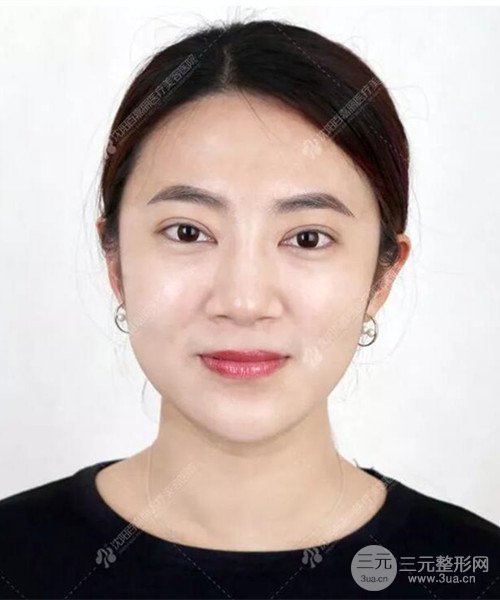 沈阳百嘉丽双眼皮+开眼角恢复日记以及前后对比图分享~