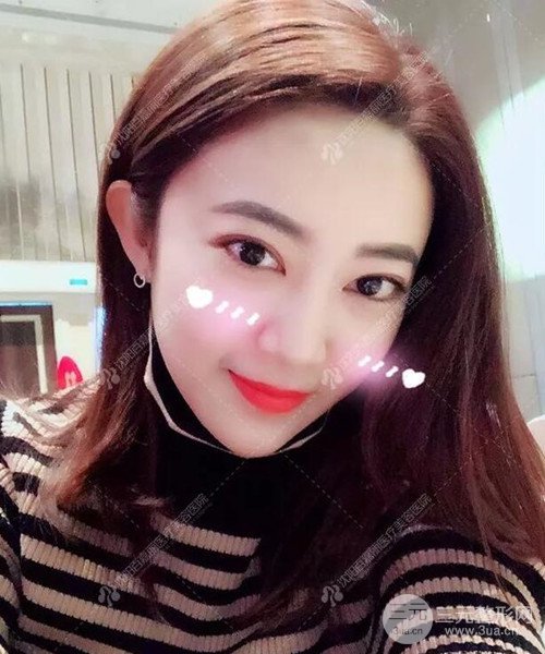 沈阳百嘉丽双眼皮+开眼角恢复日记以及前后对比图分享~