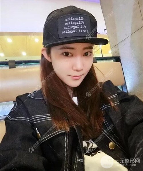 沈阳百嘉丽双眼皮+开眼角恢复日记以及前后对比图分享~