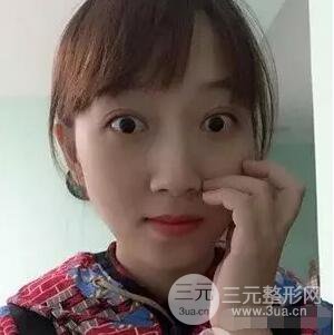 吉林铭医李红双眼皮修复前后对比图 内附吉林铭医小彩蛋哦