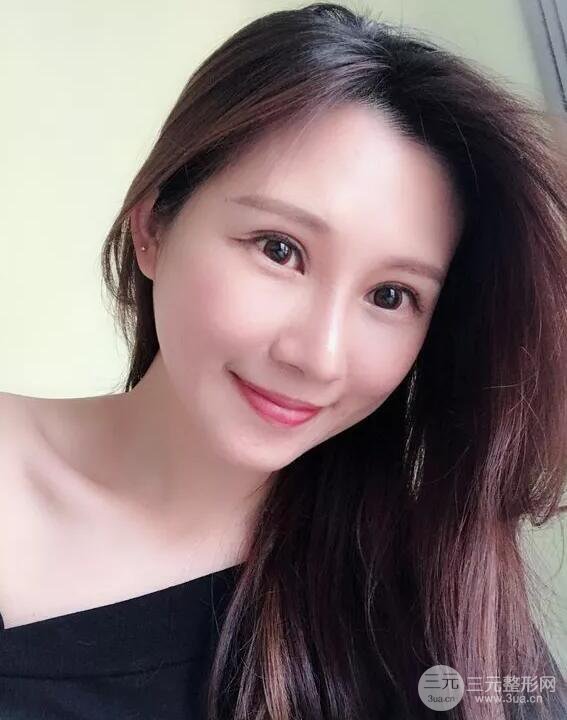 兰大二院张选奋怎么样?双眼皮修复案例前后对比图