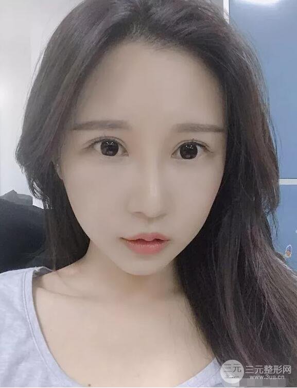 兰大二院张选奋怎么样?双眼皮修复案例前后对比图