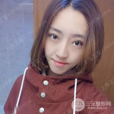 上海艺星双眼皮日记分享，割双眼皮后大变样！