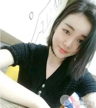 成都玉之光自体脂肪面部填充刘真人案例反馈|内附对比前后照