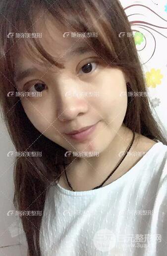 南京施尔美整形孙欣双眼皮案例恢复日记