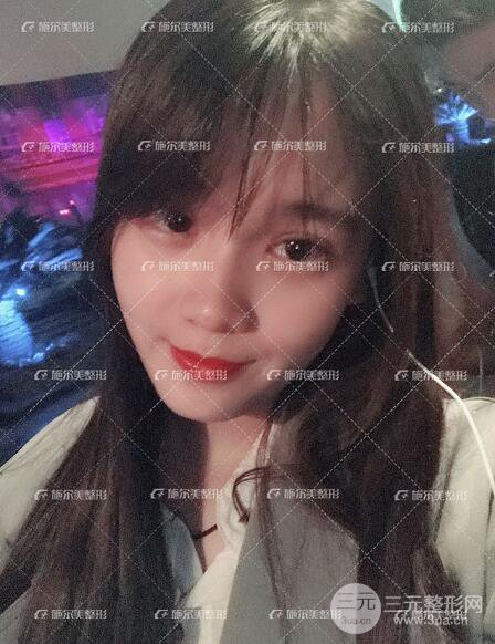 南京施尔美整形孙欣双眼皮案例恢复日记