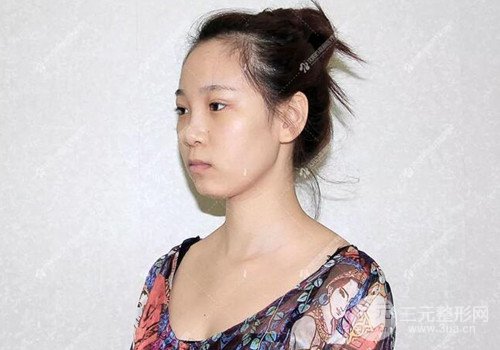 沈阳百嘉丽隆鼻整形案例前后对比图分享~
