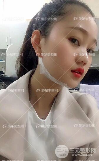 南京施尔美整形孙欣线D案例,重返17岁！