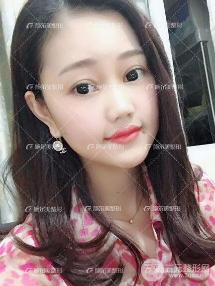 南京施尔美整形孙欣线D案例,重返17岁！