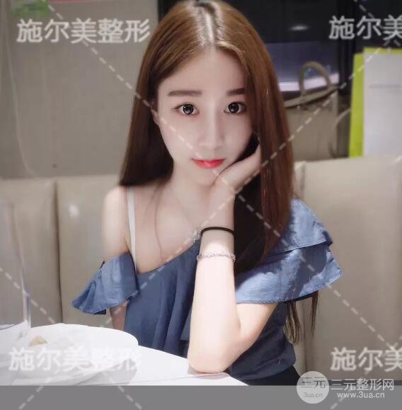 南京施尔美自体脂肪填充案例,拒绝“寿星公”！