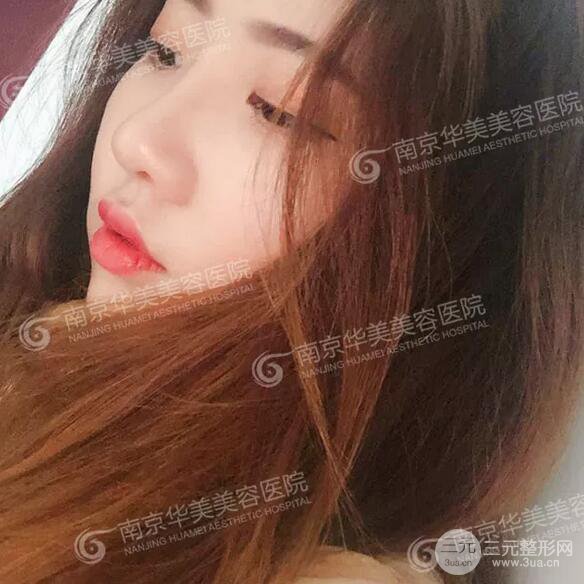 南京华美膨体隆鼻+耳软骨垫鼻尖+鼻中隔矫正案例前后对比图分享~