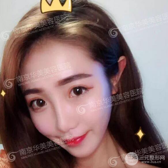 南京华美膨体隆鼻+耳软骨垫鼻尖+鼻中隔矫正案例前后对比图分享~