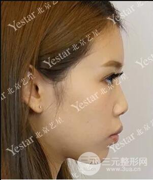北京艺星仇侃敏耳软骨隆鼻恢复过程|内附前后对比图