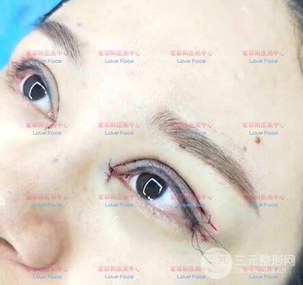 扬州艾菲斯黄婵院长双眼皮案例术后七天果