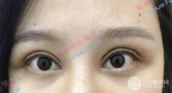 扬州艾菲斯黄婵院长双眼皮案例术后七天果