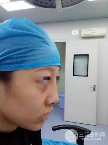 扬州艾菲斯整形隆鼻案例，自拍盛颜不是梦！