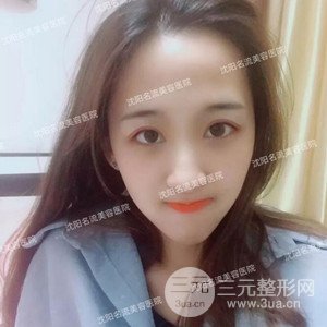 沈阳名流切开式双眼皮+开内眼角案例，前后对比图分享~