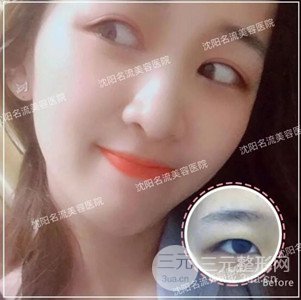 沈阳名流切开式双眼皮+开内眼角案例，前后对比图分享~