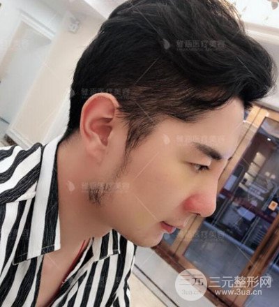 肋软骨隆鼻整形案例分享，在深圳雅涵做的!